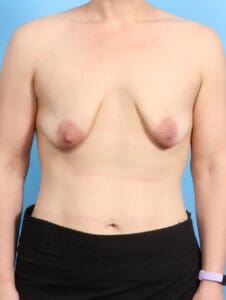Breast Lift/Reduction with Implants - Case 20731 - Before