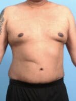 Male Tummy Tuck - Case 21176 - After