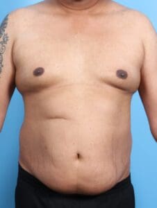 Male Tummy Tuck - Case 21176 - Before
