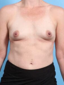 Breast Augmentation - Case 21194 - Before
