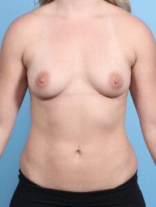 Breast Augmentation - Case 21227 - Before