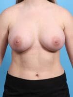 Breast Augmentation - Case 21227 - After