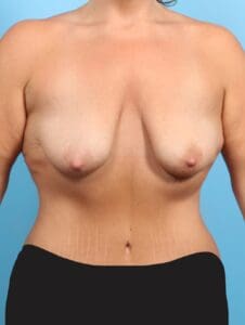 Breast Lift/Reduction with Implants - Case 21244 - Before