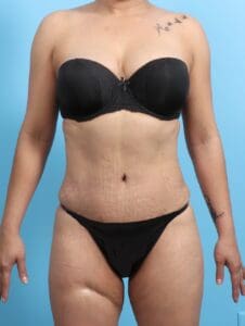 Tummy Tuck - Case 21306 - After