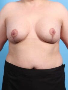 Breast Lift/Reduction with Implants - Case 21378 - After