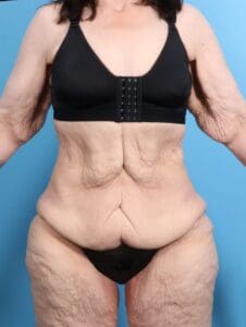 After Weight Loss - Case 21467 - Before