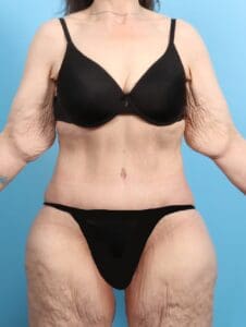 After Weight Loss - Case 21467 - After