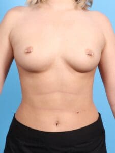 Breast Augmentation - Case 21508 - Before