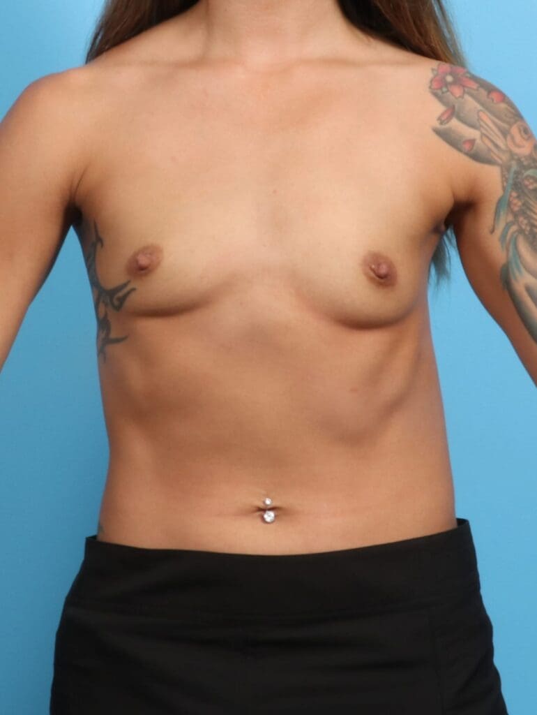 Breast Augmentation - Case 21524 - Before