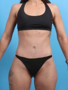 Tummy Tuck - Case 21532 - After