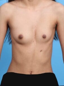 Breast Augmentation - Case 21564 - Before