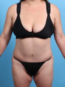 Tummy Tuck - Case 21715 - After