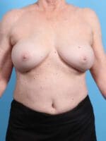 Breast Implant Revision - Case 21729 - After