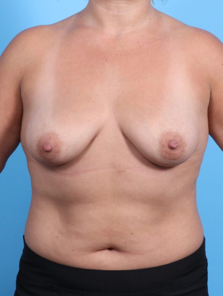 Breast Augmentation - Case 21783 - Before