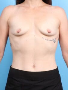 Breast Augmentation - Case 21834 - Before