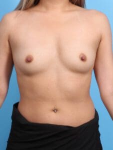 Breast Augmentation - Case 21868 - Before