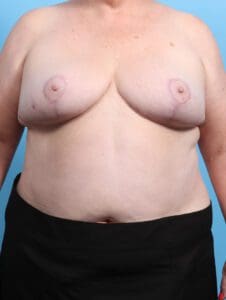 Breast Lift/Reduction w/o Implants - Case 21908 - After