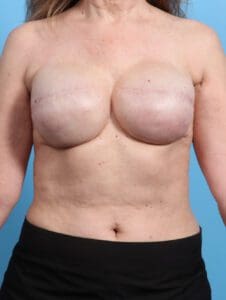 Breast Implant Revision - Case 21960 - After