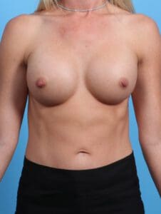 Breast Augmentation - Case 22022 - After