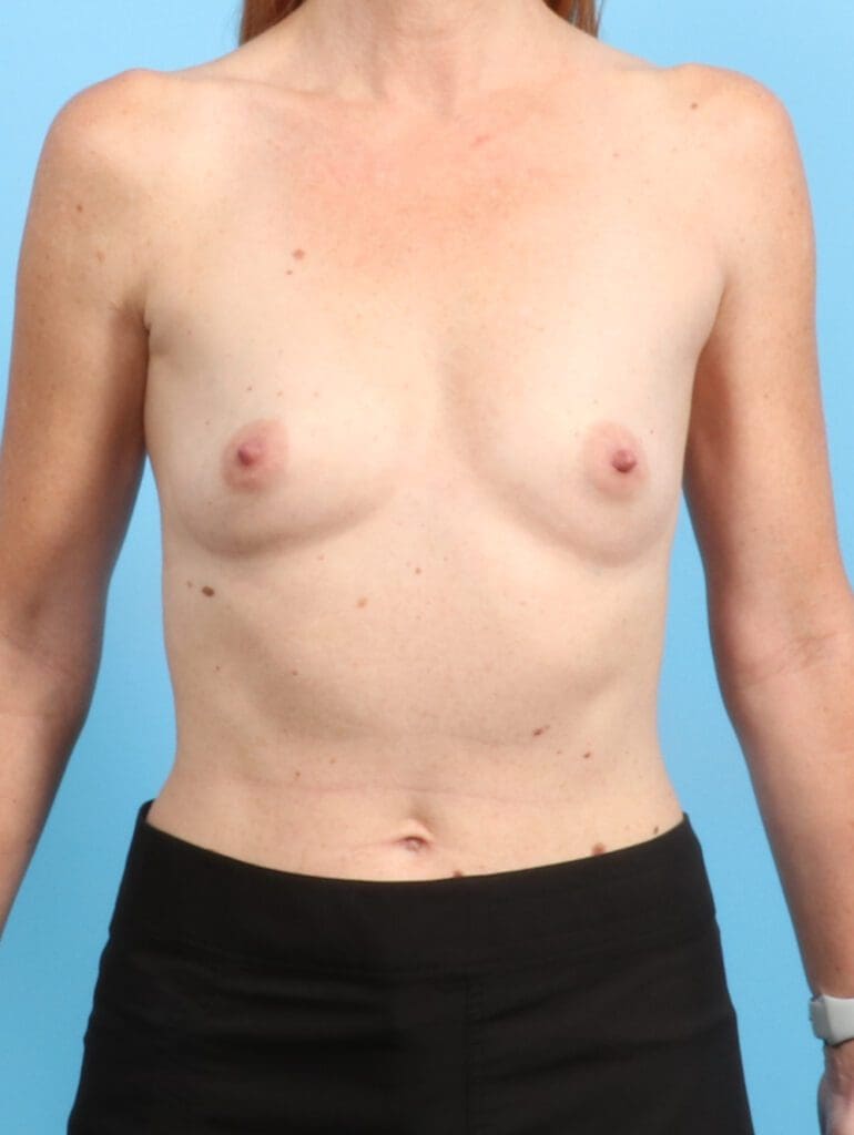 Breast Augmentation - Case 22045 - Before