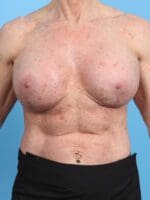 Breast Implant Revision - Case 22069 - After