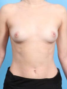 Breast Augmentation - Case 22139 - Before
