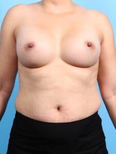 Breast Augmentation - Case 22213 - After