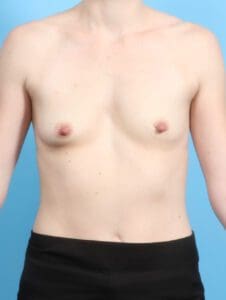 Breast Augmentation - Case 22295 - Before