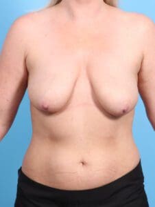 Breast Lift/Reduction with Implants - Case 22303 - Before