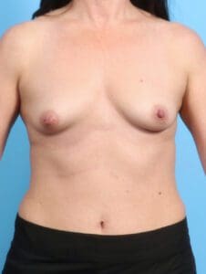 Breast Augmentation - Case 22990 - Before