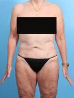 Liposuction - Case 22998 - After