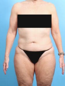 Liposuction - Case 22998 - Before