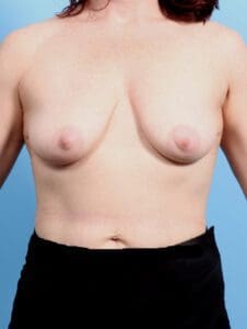 Breast Lift/Reduction with Implants - Case 23037 - Before