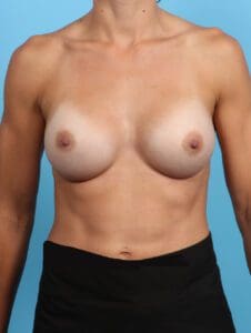 Breast Augmentation - Case 23126 - After