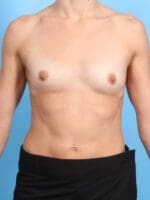 Breast Augmentation - Case 23126 - Before