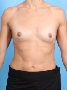 Breast Augmentation - Case 23126 - Before