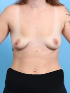 Breast Lift/Reduction with Implants - Case 23142 - Before