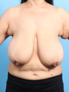 Breast Lift/Reduction w/o Implants - Case 23189 - Before