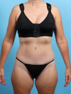 Tummy Tuck - Case 23398 - After
