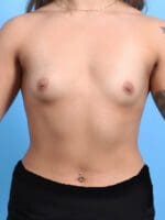Breast Augmentation - Case 23540 - Before