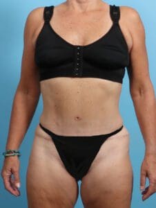 Tummy Tuck - Case 23556 - After