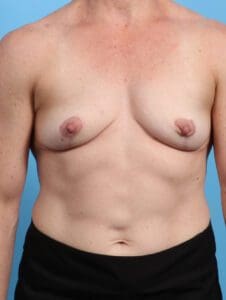Breast Implant Removal - Case 23693 - After
