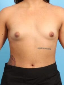 Breast Augmentation - Case 23762 - Before