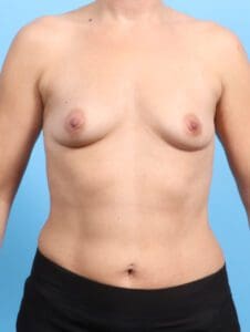 Breast Augmentation - Case 23818 - Before