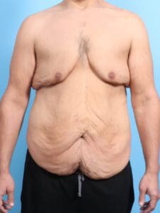 After Weight Loss - Case 23944 - Before