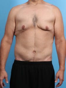 After Weight Loss - Case 23944 - After