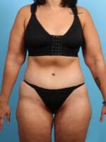 After Weight Loss - Case 24102 - After