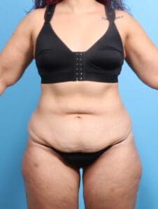 After Weight Loss - Case 24102 - Before