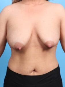 Breast Lift/Reduction with Implants - Case 24128 - Before