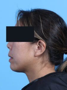 Chin Implant - Case 24220 - After
